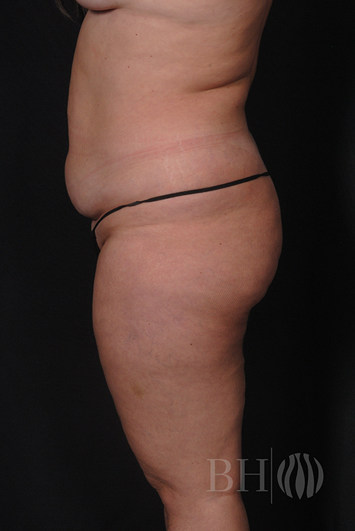 Arm Lift Before & After